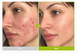 Сыворотка с азелаиновой и койевой кислотами Purito Azelaic Acid 10 Kojic Tea Tree Serum 13209 фото 3